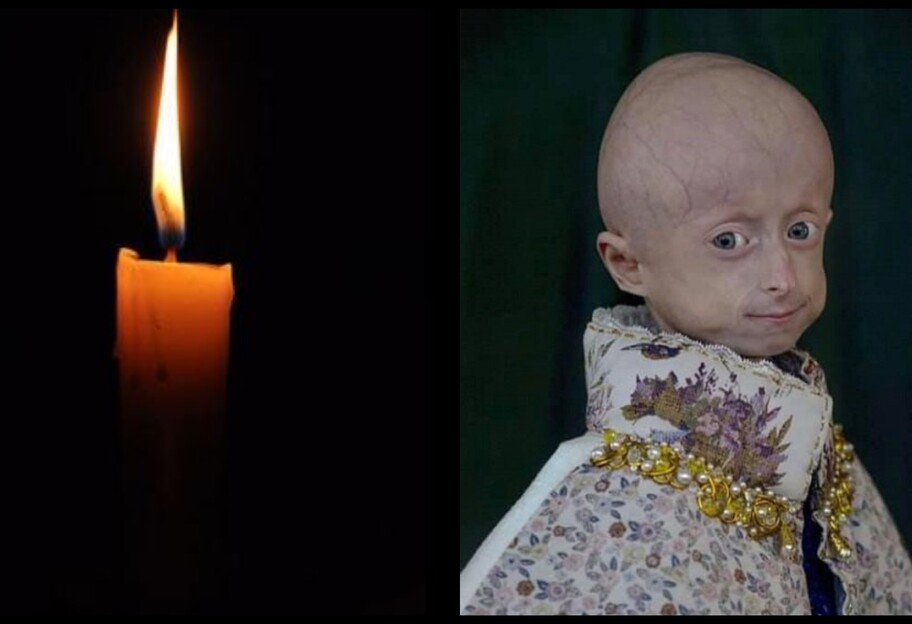 Ирина Химич умерла - она единственная в Украине болела преждевременным старением - фото 1