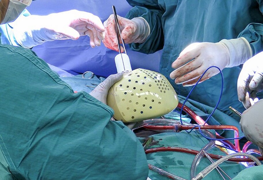 Пересадка сердца - компания Carmat впервые продала искусственный орган - фото - фото 1